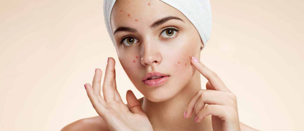 acne-natural-facial-masks-diy-problem-skin